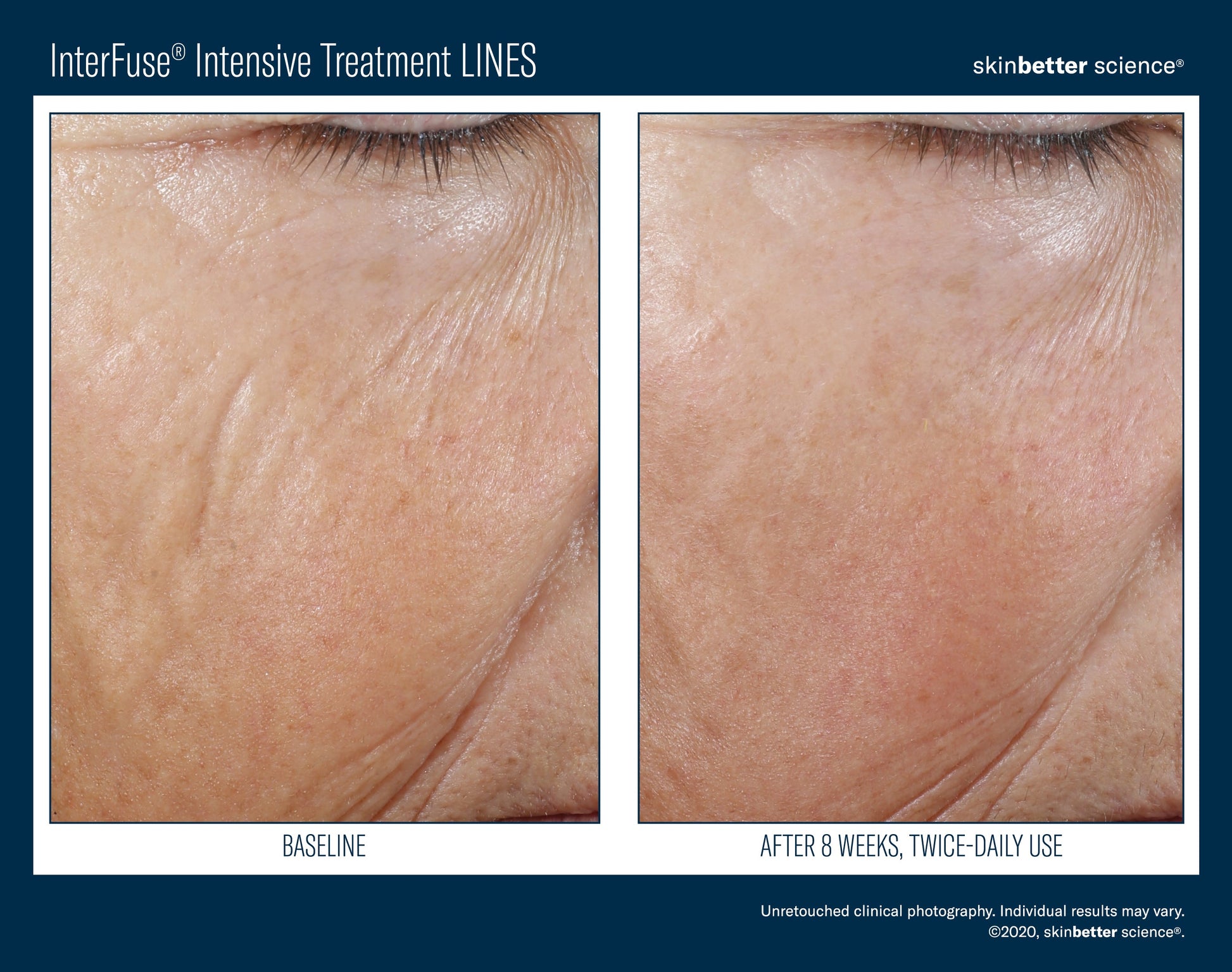 InterFuse Intensive Treatment LINES 15 ml