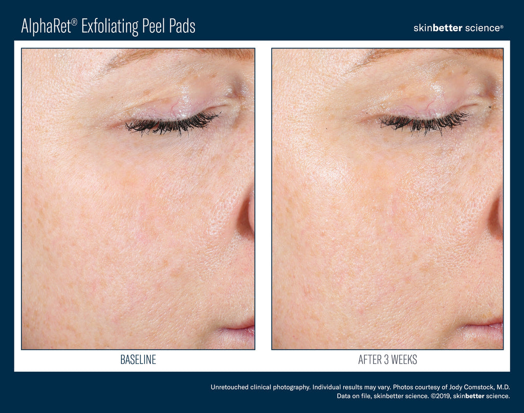 AlphaRet Exfoliating Peel Pads