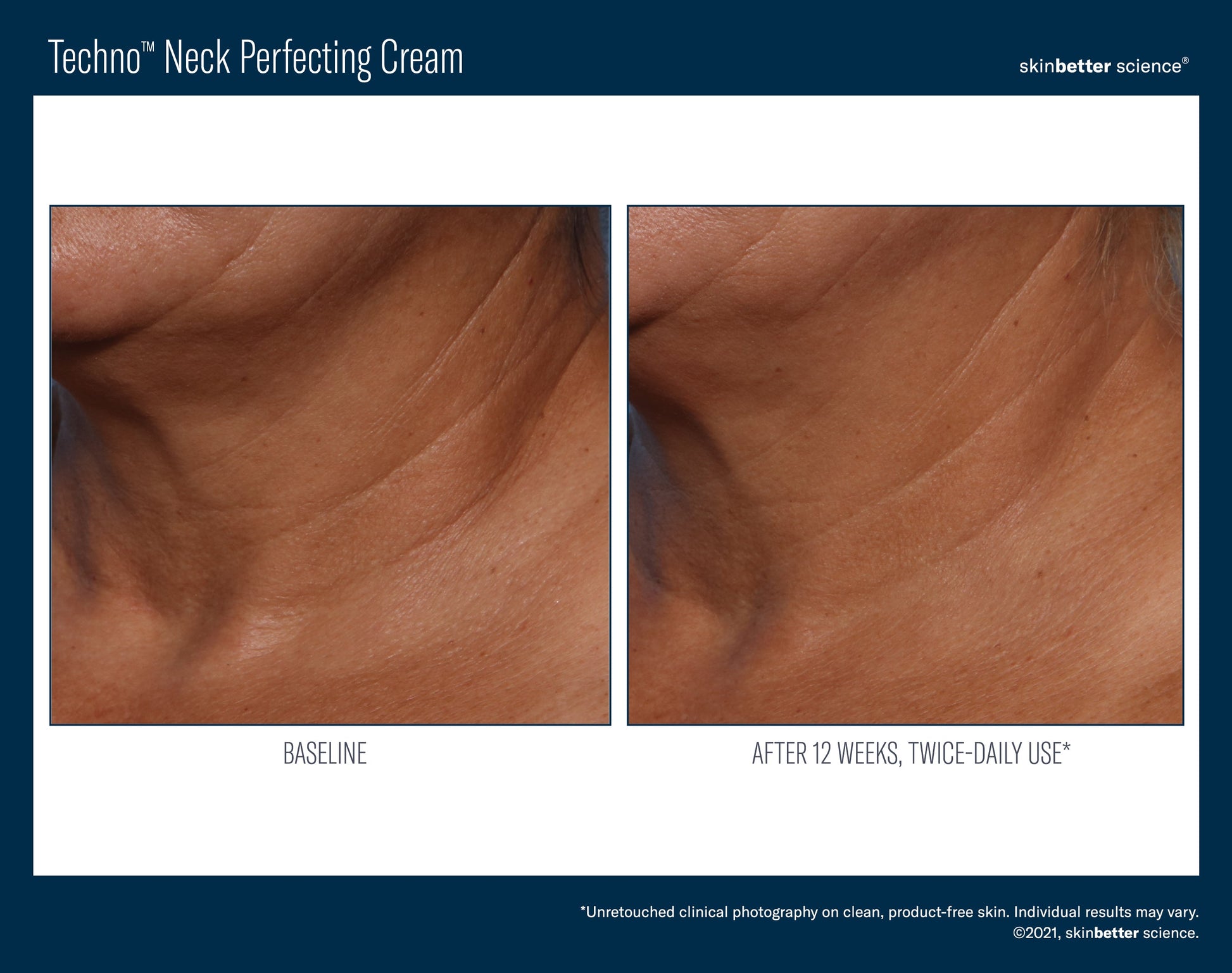 Techno Neck Perfecting Cream